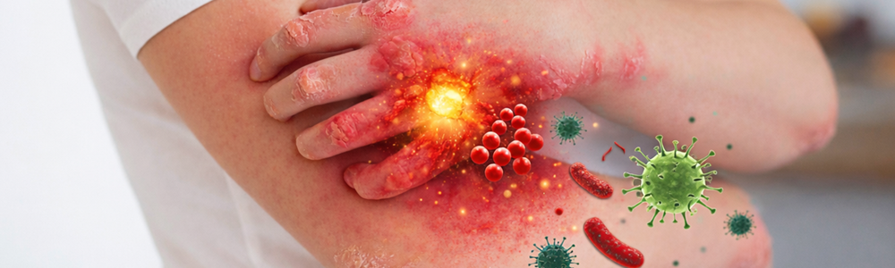 Infection risk among psoriasis biologic-new users: A cohort study on the French National Health Data System