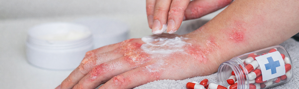 Antibiotic Use and the Persistence of Biologic Therapies in Patients With Psoriasis